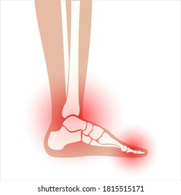 Arthritis joint in the ankle. Rheumatoid arthritis. Pain in leg. Human foot bone anatomy flat vector illustration. Skeleton x ray scan concept. Painful injury and erosion. Medical poster for clinic.