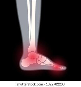 Arthritis joint in the ankle. Rheumatoid arthritis. Pain in leg. Human foot bone anatomy flat vector illustration. Skeleton x ray scan concept. Painful injury and erosion. Medical poster for clinic.