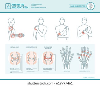 Arthritis and joint pain infographic, anatomic illustration of an inflammed hand and arm