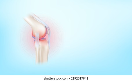 Arthritis knee joint and cartilage osteoarthritis side on blue background with copy space for text. Bone human skeleton anatomy of the body. Medical health care science concept. Realistic 3D Vector.