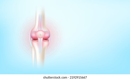 Arthritis knee joint and cartilage osteoarthritis side on blue background with copy space for text. Bone human skeleton anatomy of the body. Medical health care science concept. Realistic 3D Vector.