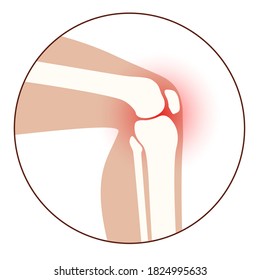 Gelenksymbol für Arthritis. Klinisches Logo für die Rheumatoide Arthritis. Schmerzen im Bein. Menschliche Knochenanatomie, flache Vektorgrafik. Skeletton-Röntgenabtastung Schmerzhafte Verletzungserosion auf dem medizinischen Poster für die Klinik.