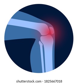 Arthritis knee joint icon. Rheumatoid arthritis clinic logo. Pain in leg. Human bone anatomy flat vector illustration. Skeleton x ray scan concept. Painful injury erosion on medical poster for clinic.