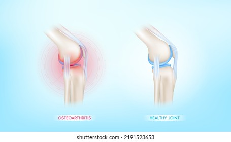 Arthritis Knee Joint In Leg And Bone Healthy. Human Bone Anatomy Damage Treatment Osteoarthritis. Skeleton X Ray Scan Concept. Vector EPS10 Illustration.