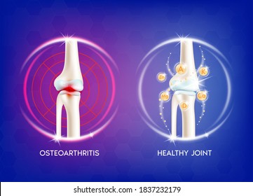 Arthritis knee joint. Pain in leg. Human bone anatomy. Skeleton x ray scan concept and Vitamin therapy. Vector EPS10 illustration