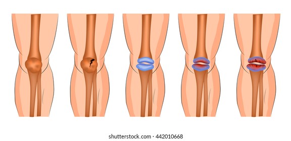 arthritis of the knee joint, protrusion, fracture of the patella
