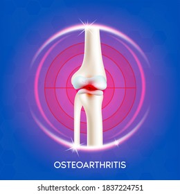 Arthritis knee joint. Rheumatoid arthritis clinic logo. Pain in leg. Human bone anatomy. Skeleton x ray scan concept. Painful injury and erosion. Vector EPS10 illustration.