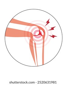 Arthritis in knee joint stock illustration. Pain in kneecap joint Arthritis knee joint pain syndrome knee Skeleton stock illustration
