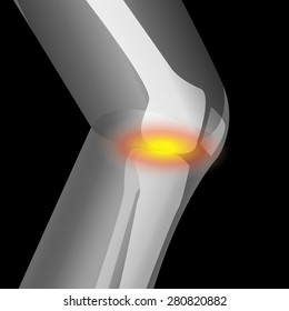 arthritis in knee, pain of knee, suffering from knee, Knee bone x-ray film