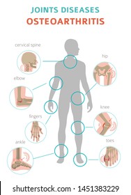 Arthritis, osteoarthritis medical infographic design. Joint replacement, implantant. Vector illustration