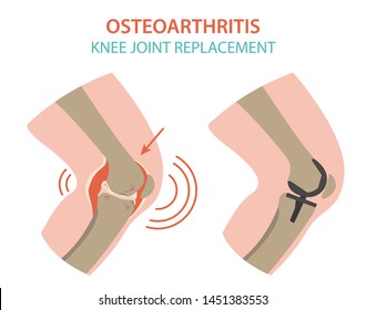 Arthritis, osteoarthritis medical infographic design. Joint replacement, implantant. Vector illustration