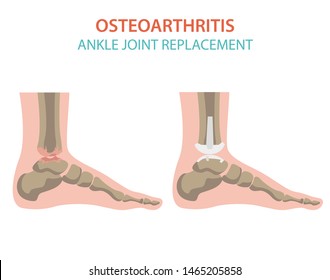 Arthritis, osteoarthritis medical infographic design. Joint replacement, implantant. Vector illustration