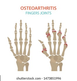 Arthritis, osteoarthritis medical infographic design. Joint replacement, implantant. Vector illustration