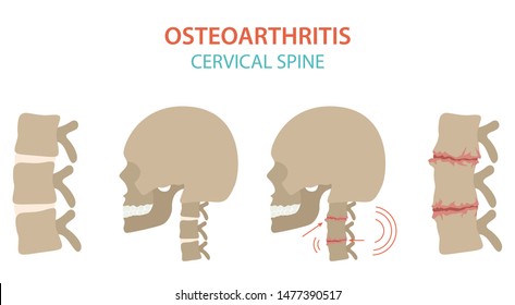 Arthritis, osteoarthritis medical infographic design. Joint replacement, implantant. Vector illustration