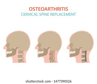 Arthritis, osteoarthritis medical infographic design. Joint replacement, implantant. Vector illustration