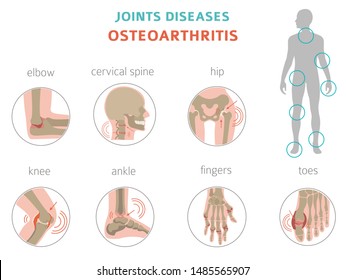 Arthritis, osteoarthritis medical infographic design. Joint replacement, implantant. Vector illustration