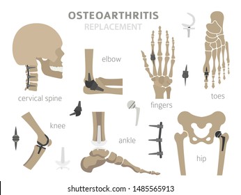 Arthritis, osteoarthritis medical infographic design. Joint replacement, implantant. Vector illustration