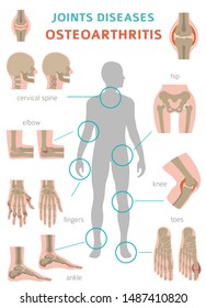 Arthritis, osteoarthritis medical infographic design. Joint replacement, implantant. Vector illustration