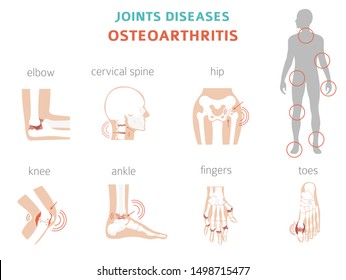Arthritis, osteoarthritis medical infographic design. Joint replacement, implantant. Vector illustration