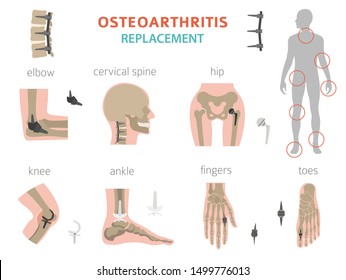 Arthritis, osteoarthritis medical infographic design. Joint replacement, implantant. Vector illustration