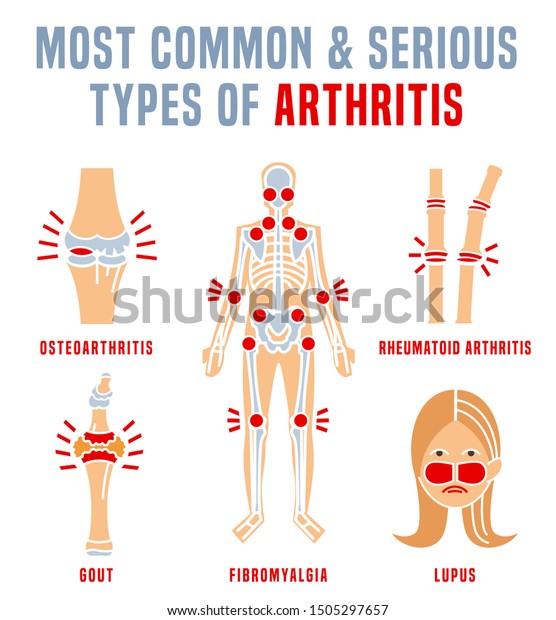 関節炎の種類のインフォグラフィック 人体 の関節痛 白い背景に明るい色のベクターイラスト モダンフラットスタイル グラフィックデザイン 医療 健康的なライフスタイルのコンセプト のベクター画像 素材 ロイヤリティフリー