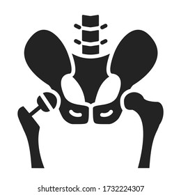 Icono negro de glifo de artroplastia. Implante de reemplazo de cadera instalado en el hueso pelvis. Elemento vector aislado. 