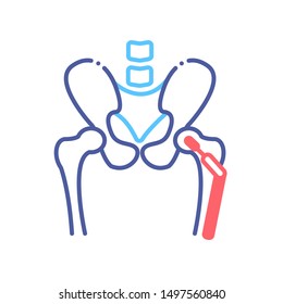 Arthroplasty Line Color Icon. Hip Replacement Implant Installed In The Pelvis Bone. Sign For Web Page, Mobile App, Button, Logo. Vector Isolated Button. Editable Stroke.