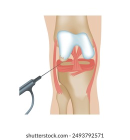 Artroscopia de la articulación de la rodilla. Cirugía o diagnóstico mediante una punción con artroscopio. Ilustración vectorial médica.