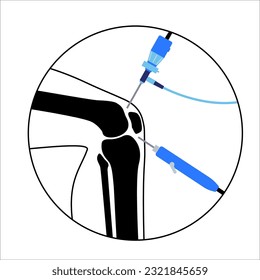 Arthroscopy medical procedure. Knee joint minimally invasive surgery. Arthroscope and arthroscopic instrument. Patella replacement, leg injury, kneecap reconstruction. Ligament and meniscus vector.