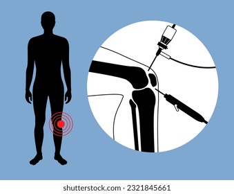 Arthroscopy medical procedure. Knee joint minimally invasive surgery. Arthroscope and arthroscopic instrument. Patella replacement, leg injury, kneecap reconstruction. Ligament and meniscus vector.