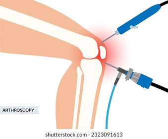 Arthroscopy medical procedure. Knee joint minimally invasive surgery. Arthroscope and arthroscopic instrument. Patella replacement, leg injury, kneecap reconstruction. Ligament and meniscus vector.