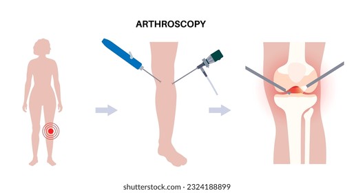 Arthroscopy medical procedure. Knee joint minimally invasive surgery. Arthroscope and arthroscopic instrument. Patella treatment, leg pain, kneecap inflammation. Ligament and meniscus anatomy vector.