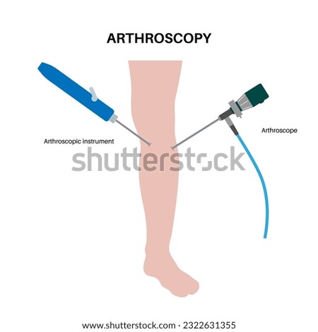 Arthroscopy medical procedure. Knee joint minimally invasive surgery. Arthroscope and arthroscopic instrument. Patella replacement, leg injury, kneecap reconstruction. Ligament and meniscus vector. Stock photo © 