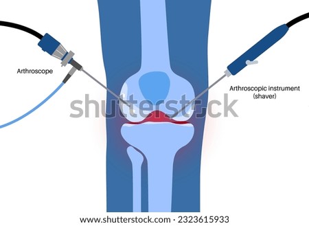 Arthroscopy medical procedure. Knee joint minimally invasive surgery. Arthroscope and arthroscopic instrument. Patella treatment, leg pain, kneecap inflammation. Ligament and meniscus anatomy vector. Stock foto © 