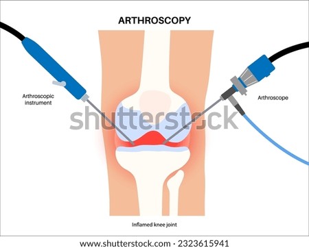 Arthroscopy medical procedure. Knee joint minimally invasive surgery. Arthroscope and arthroscopic instrument. Patella treatment, leg pain, kneecap inflammation. Ligament and meniscus anatomy vector. Stock photo © 