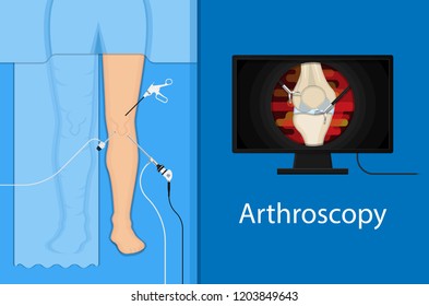 Arthroscopy medical treatment surgery keyhole surgical treat endoscope Anterior cruciate ligament  ACL orthopedic Hip Ankle Elbow