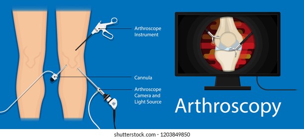 Arthroscopy medical treatment surgery keyhole surgical treat endoscope Anterior cruciate ligament  ACL orthopedic Hip Ankle Elbow