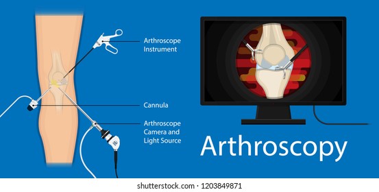 Arthroscopy medical treatment surgery keyhole surgical treat endoscope Anterior cruciate ligament  ACL orthopedic Hip Ankle Elbow