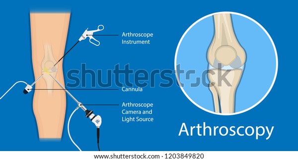 Arthroscopy Medical Treatment Surgery Keyhole Surgical Stock Vector Royalty Free 1203849820 4452