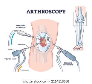 Arthroscopy procedure process explanation from medical view outline diagram. Labeled educational knee joint diagnosis and treatment with trimming instrument, scope and irrigation vector illustration.