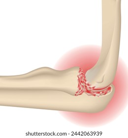 Arthrosis of the elbow joint. Realistic rendering of hand bones. Medical poster. Isolated vector illustration
