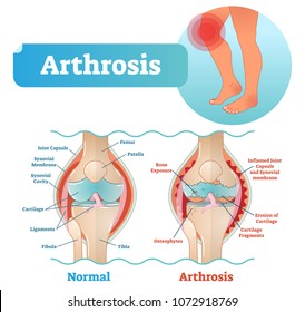 poly artrosis kezelés