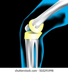 Artificial bone knee, X-Ray, Knee Scan