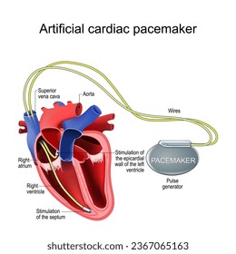 Artificial cardiac pacemaker. Heart implant. Treatment of a Bradycardia, Tachycardia, Arrhythmia. Cross section of a human heart with Pulse generator to stimulate the septum, and epicardial wall