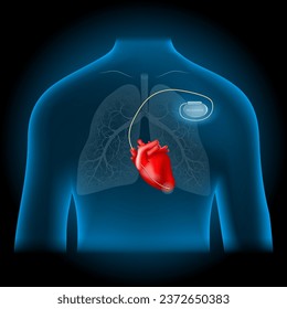 Artificial cardiac pacemaker location. realistic heart and pacemaker into blue torso. Human silhouette on dark background. vector illustration like X-ray image