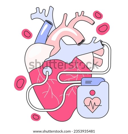Artificial cardiac pacemaker. Medical device that generates electrical impulses delivered by electrodes to the chambers of the heart. Flat vector illustration