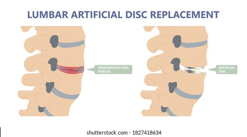 Degenerative Disk Disease Symptome von Rückenschmerzen oder Nackenschmerzen mit Scheibenwechsel zur Behandlung