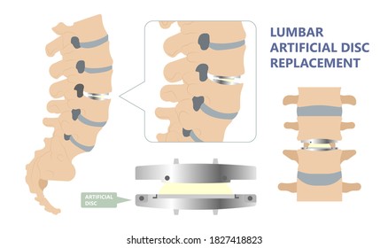 Artificial Disc for Treatment the Degenerative Disc Disease arthritis osteoarthritis spondylosis ankylosing spondylitis slipped