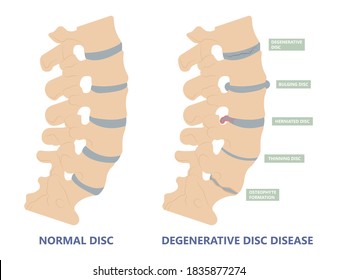 Artificial Disc for Treatment the Degenerative Disc Disease arthritis osteoarthritis spondylosis ankylosing spondylitis slipped