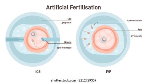 Artificial fertilization types. Female egg insemination by sperm with IVF and ICSI technology. Female egg and male sperm in a petri dish. Microscopic view. Flat vector illustration